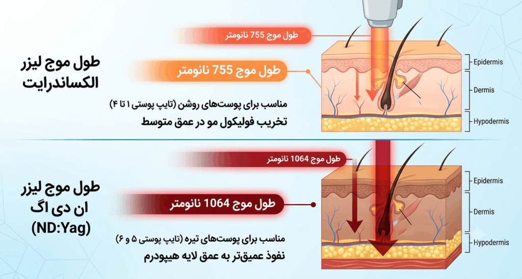 لیزر مو الکساندرایت | لیزر مو ان‌دیاگ